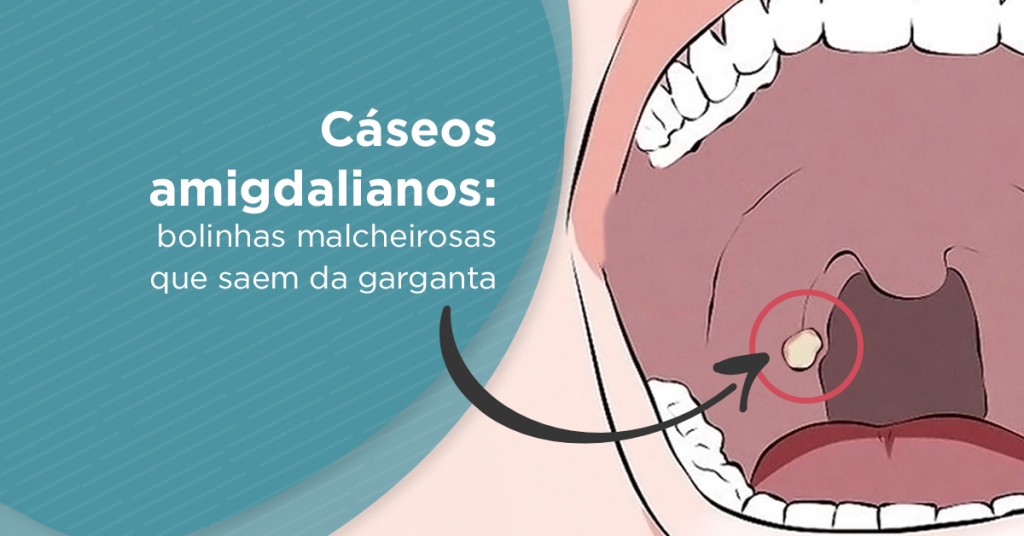 Como se formam os cáseos, aquelas massinhas / bolinhas nas