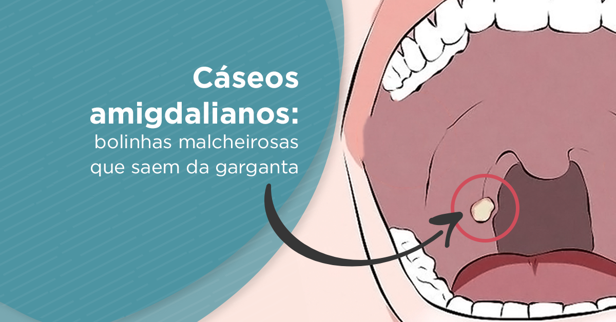 Cáseos amigdalianos: bolinhas malcheirosas que saem da garganta - Fique por Dentro - ABHA | Associação Brasileira de Halitose