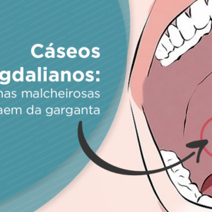 Cseos amigdalianos: bolinhas malcheirosas que saem da garganta
